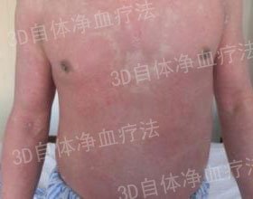 成都银康银屑病医院 怎样才能治好牛皮癣