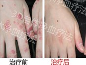 成都银屑病研究院附属医院 点滴状牛皮癣怎么治疗好