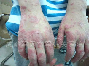 成都银康银屑病医院 治疗牛皮癣最好偏方