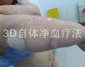 成都银康银屑病医院 银屑病初期症状