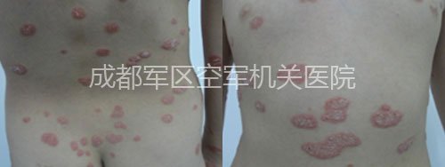 8岁儿童战胜银屑病 拥抱快乐童年